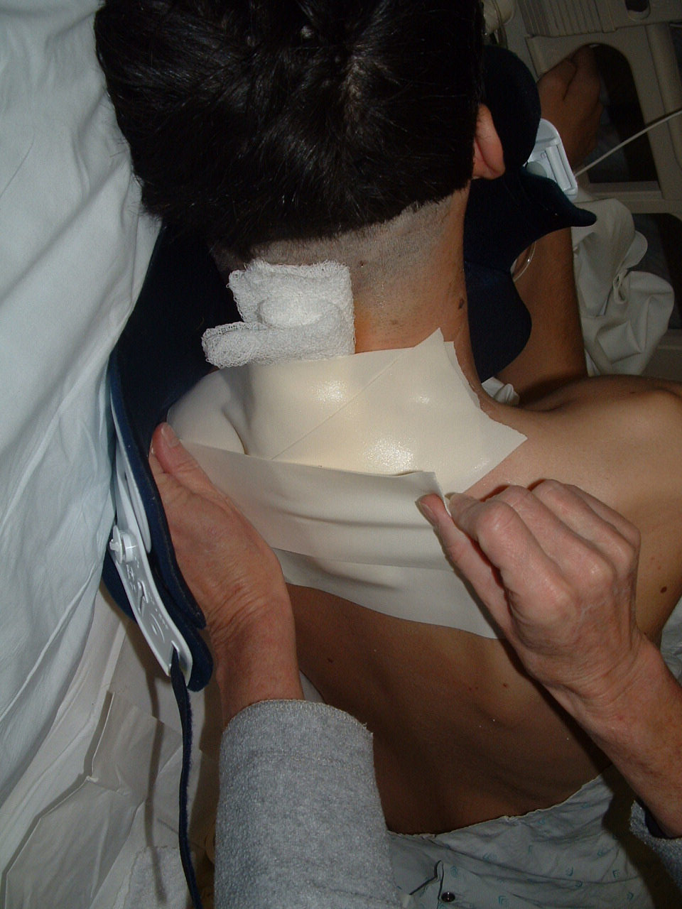Then there’s the incision on my neck, at first it was covered with a ton of thick absorbent pads like so.